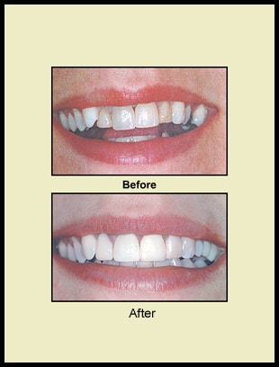 Before & After Prosthodontics Reference 2 before and after comparison of a Prosthetic Dentistry patient of Columbus, OH restorative dentist Dr. Firouzian