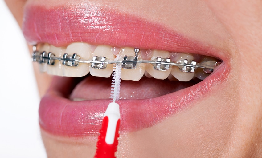 closeup of woman caring and cleaning her traditional metal braces