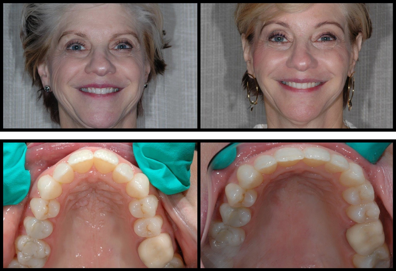 before and after comparison of patient of Dr. Firouzian
