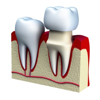 Dental Crowns: Strength and Beauty