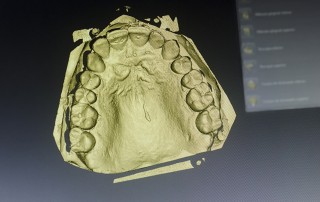 Digital rendering of a 3D printed provisional restorations–the ones you wear while waiting for your permanent restoration.