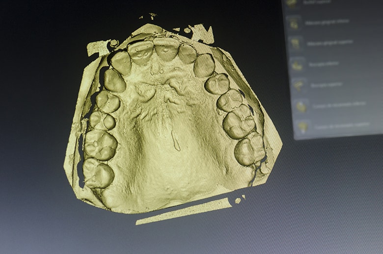 Dental technician is designing a dental crown with a computer. At Firouzian Dentistry, we strive to utilize the best dental technology to deliver the best dental care to our patients which is why we offer 3D printed provisional restorations–the ones you wear while waiting for your permanent restoration. 