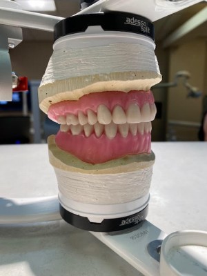 mold of a new smile using dental implants and restorations