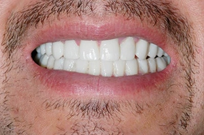 Close Up After Treatment