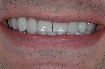 Close Up After Treatment