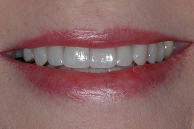 After Treatment