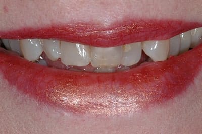 Before Treatment